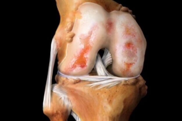 Destruction of the knee joint due to osteoarthritis - a common pathology of the musculoskeletal system