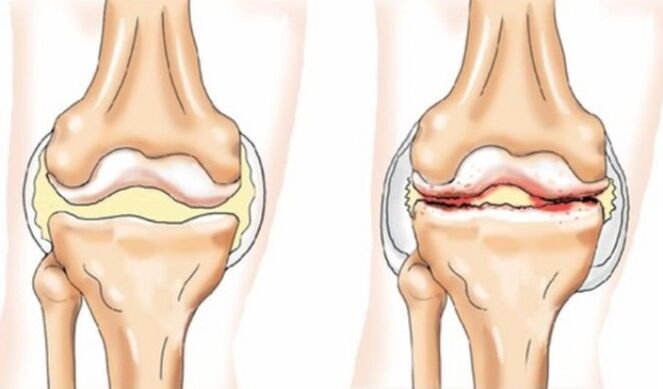 Differences in arthritis and osteoarthritis