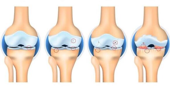 Osteortrose stages