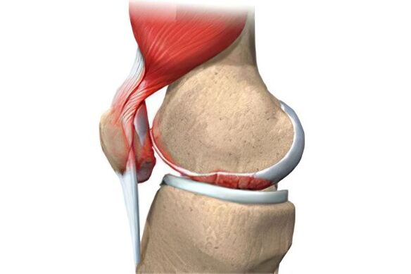 Osteoarthritis complications