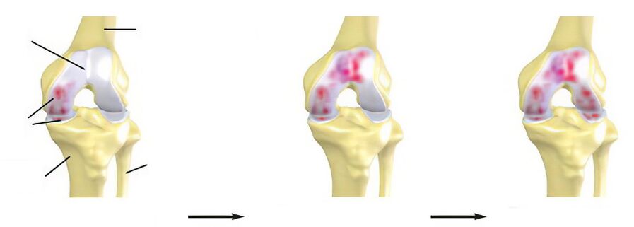 Osteoarthritis stages