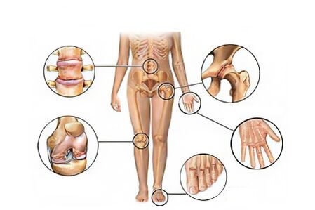 Types of osteoarthritis