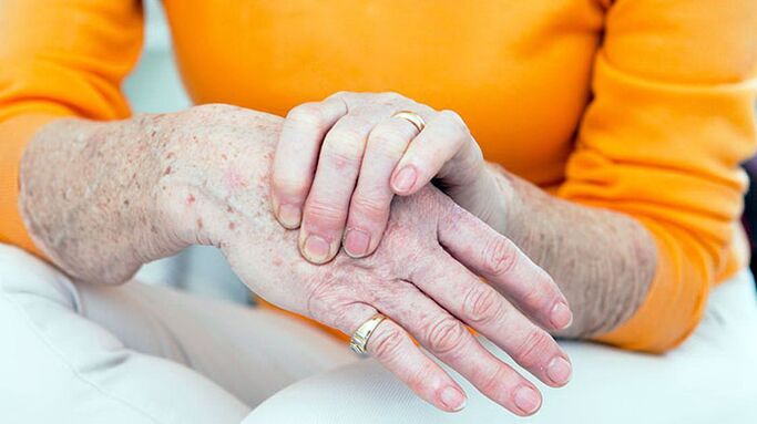 Brush osteoarthritis