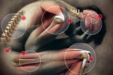 Osteoarthritis