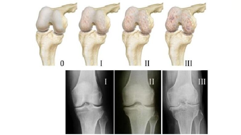 Stages of osteoarthritis of the knee joint on x-rays
