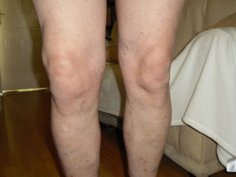 healthy knee and osteoarthritis of the knee joint