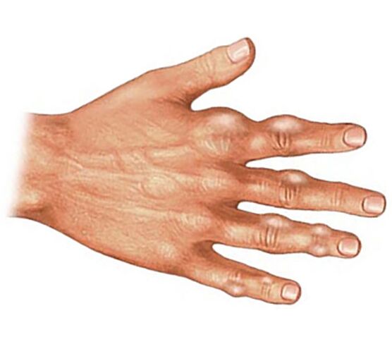 Deposition of uric acid crystals in the soft tissues of the fingers in gouty arthritis