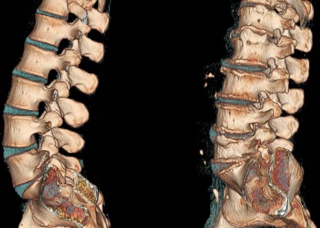 CT of the lumbar spine under normal conditions and with osteochondrosis